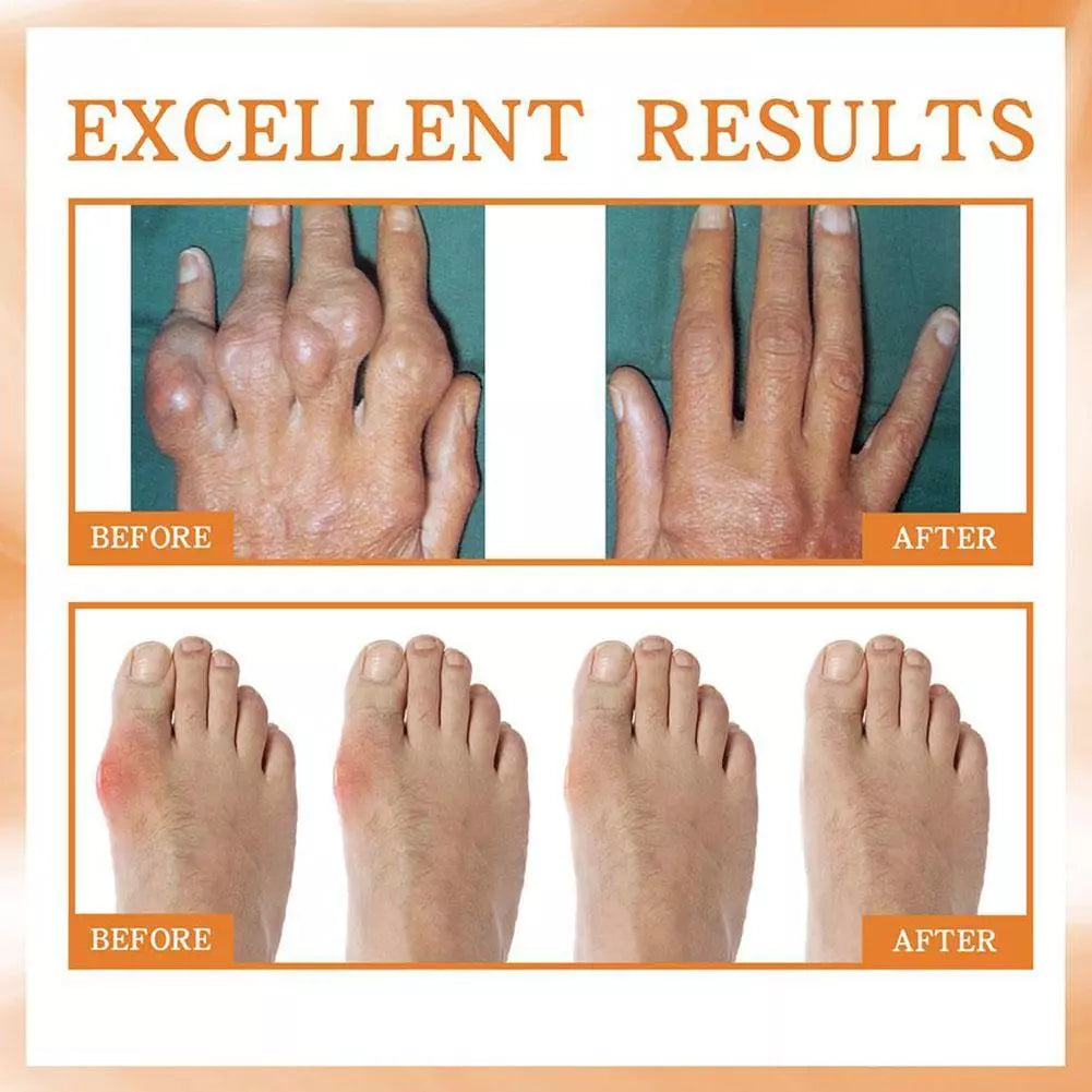 Gout treatment spray